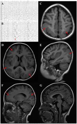 Case report: Genotype and phenotype of DYNC1H1-related malformations of cortical development: a case report and literature review